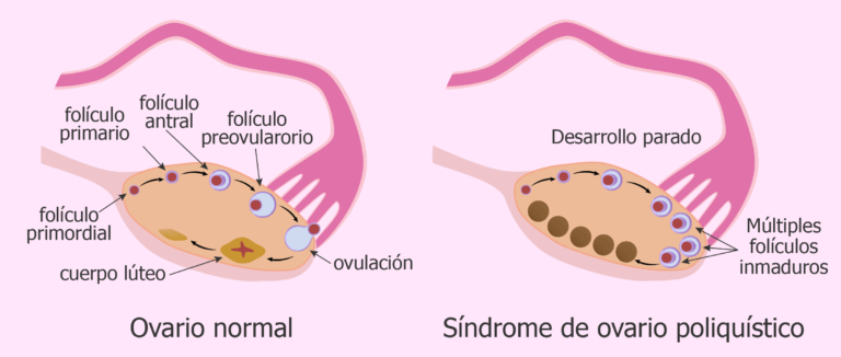 ovarios poliquistico ginecologos en guadalajara